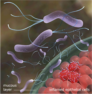 H. Pylori